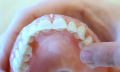 Zubní protézy
